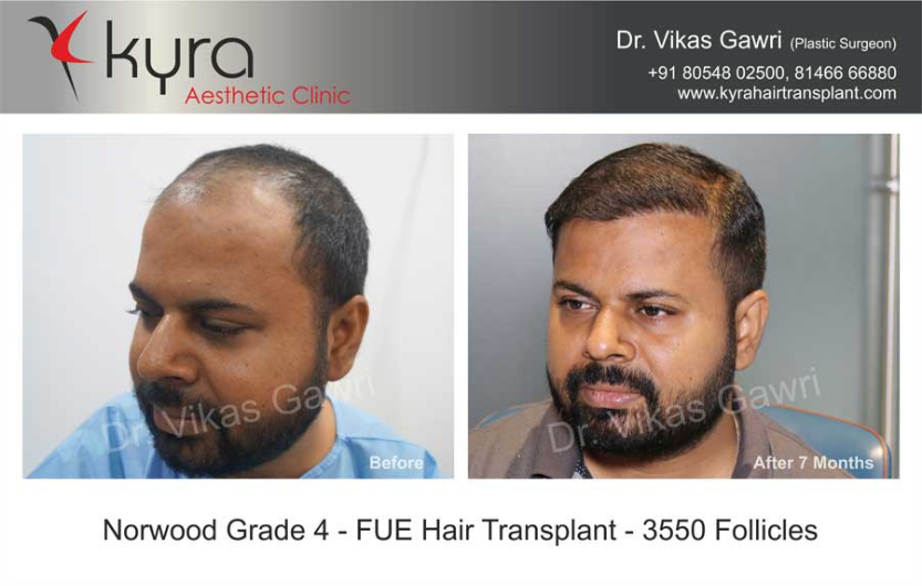 Hair Transplant In Ludhiana Punjab Cosmetic Surgeon In Ludhiana Punjab